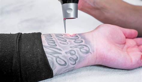 Tattoo Removal In Surrey Who Seeks Laser ? Connecticut