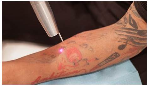 Everything You Need to Know About How Tattoos Are Removed - Study IQ