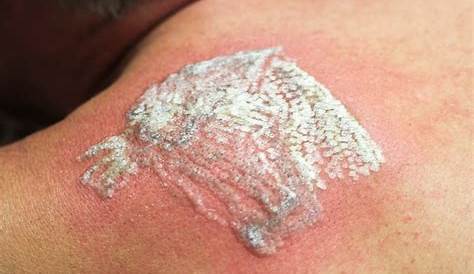 Tattoo Removal Itchy Laser Skin Coloradocampervanrental