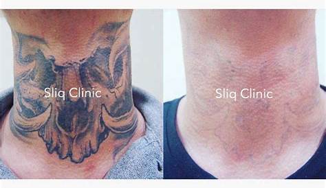 Tattoo Removal Kuala Lumpur Best Laser Clinic & Selangor