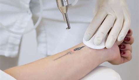 Tattoo Removal Laser Aftercare Permanent In Dubai Skin Care Clinic