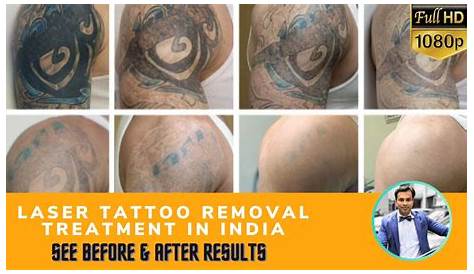 Tattoo Removal Laser Cost In India Álbumes 100+ Foto Como Eliminar Un