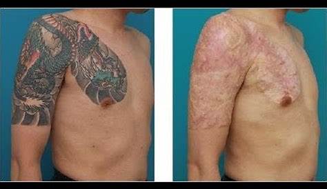 Tattoo Removal Laser Side Effects Alka Skin Clinic Price In Nepal Before