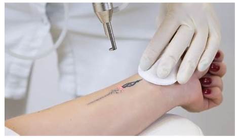 Tattoo Removal Laser Treatment Near Me What Is Involved With Relief? MD