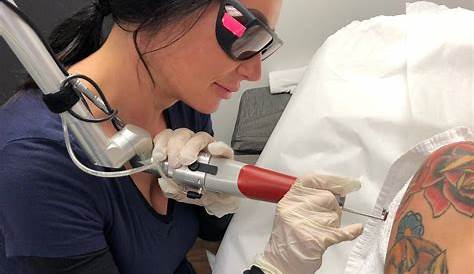 Tattoo Removal Laser Cost And How To Do