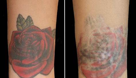 Tattoo Removal Miami In PainFree Laser Treatment Ink Off