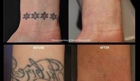 Tattoo Removal More Painful How Is A