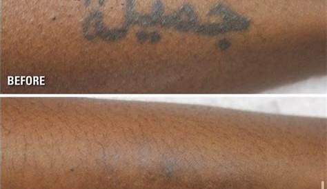 Tattoo Removal On Black Skin Alka Laser Clinic Laser Price In Nepal