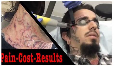 Tattoo Removal Painful Reddit Is ? No Lets Bust That Myth Daily