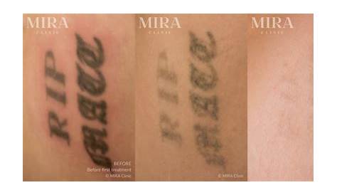 Tattoo Removal Perth Laser Medaesthetics