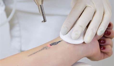 Tattoo Removal Plymouth Cost