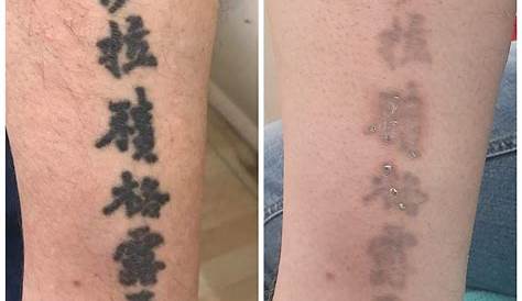 Tattoo Removal Results After One Treatment Top 123+ Before And Photos