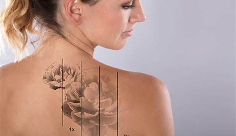 Tattoo Removal, Laser Chicago PicoSure Derick Dermatology