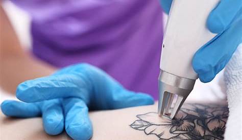 Tattoo Removal Training In Cape Town Prices Rusticweddingoutfitguestwomen