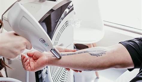Tattoo Removal Training Scotland Webinar What To Expect From Laser Astanza