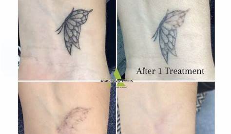 Tattoo Removal Uk Bolton Contact UK