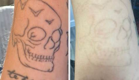 Tattoo Removal Uk Manchester UK Certified Laser In