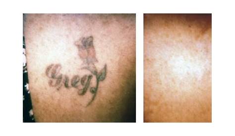 Tattoo Removal Winnipeg Prices 5th Convention August 2023 Canada INKPPL