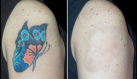 Tattoo Removal With Color Bright YouTube
