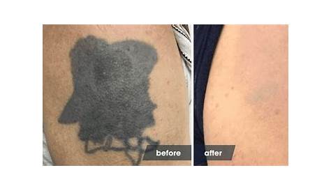 Tattoo Remove From Skin Removal Before After Before And After Photos