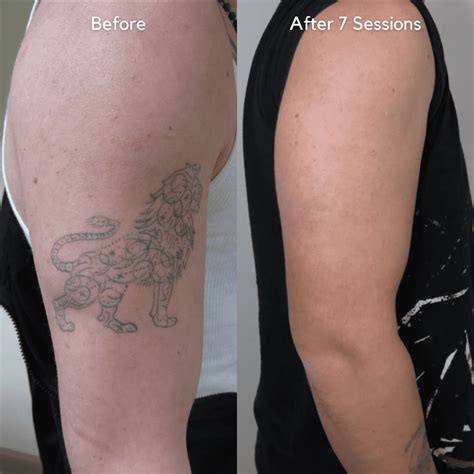 tattoo removal before and after photos
