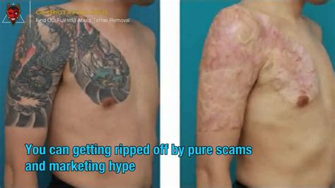 tattoo removal cost long island