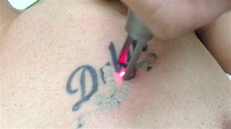 tattoo removal in los angeles