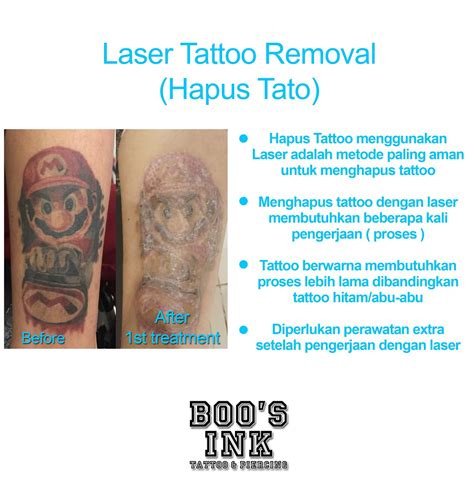 Tattoo Removal In Jakarta: Everything You Need To Know In 2023