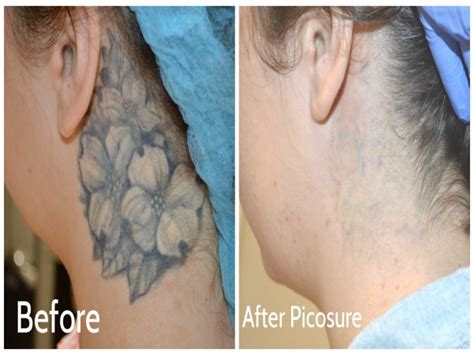 tattoo removal melbourne fl