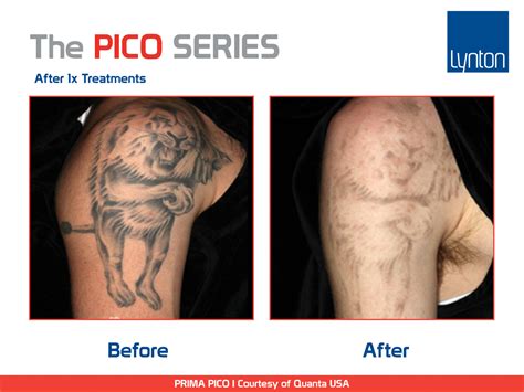 tattoo removal pico laser