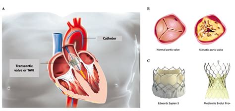 Tavi Aortic Valve Procedure: Minimally Invasive Heart Treatment Explained