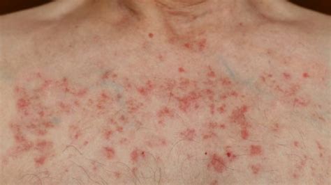taxol induced rash