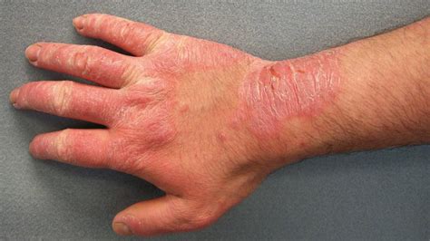 taxol rash on hands