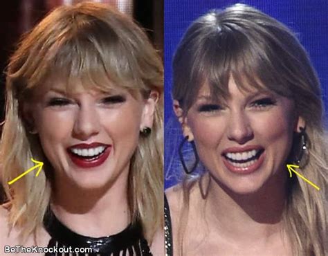 Taylor Swift Botox: Secret Unveiled