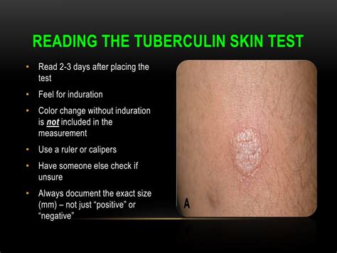 Understanding the TB Skin Test: What You Need to Know About Diagnosis and Treatment