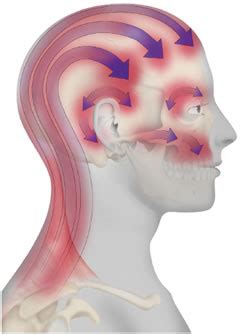 Tcm Tension Headache