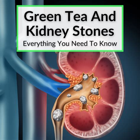 Tea Kidney Stone