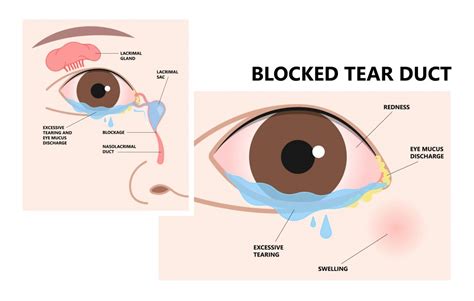 Tear Duct Inflammation: Causes, Symptoms, and Effective Treatments