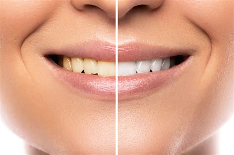 Teeth Whitening Services Las Cruces, NM Gentle Care Dentistry