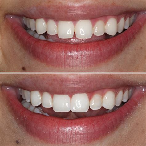 Teeth Treat Before and after teeth whitening at dentist