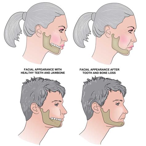 Teeth Affect Face Shape