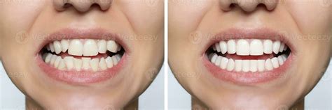 Teeth Bleaching And Veneers