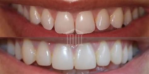 Teeth Bonding Nottingham