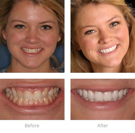 teeth correction recovery