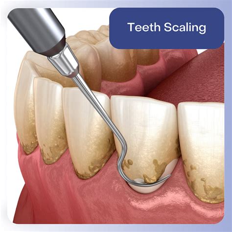 Teeth Deep Cleaning Services