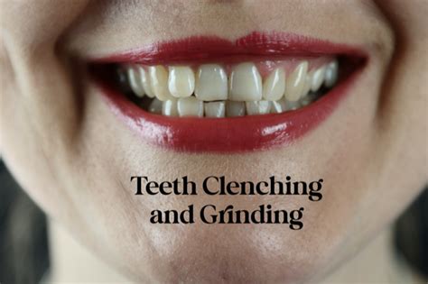 Teeth Grinding Or Clenching