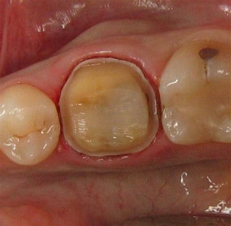 Teeth Hurt After Crown Prep