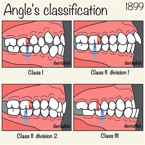 Teeth Occlusion Classification