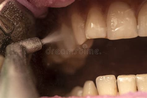 Teeth Sandblasting