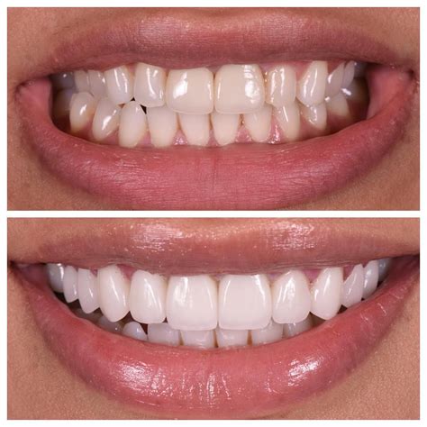 teeth veneers before and after pictures